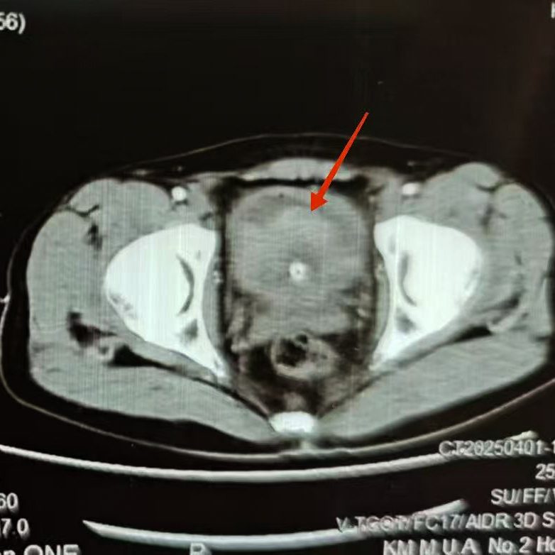 Bladder cancer · recurrent gross hematuria