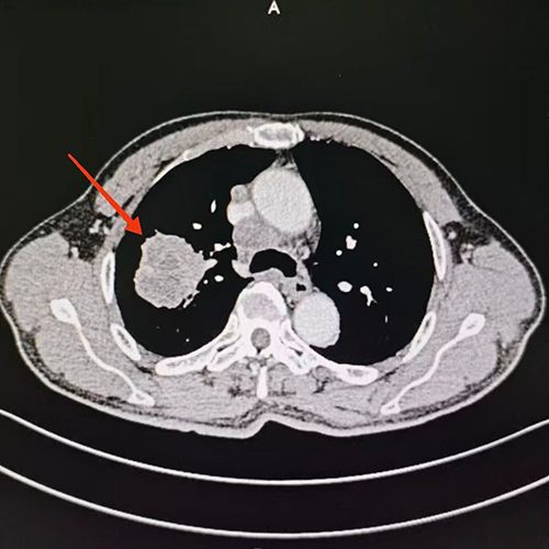 Right lung squamous cell carcinoma with multiple metastases