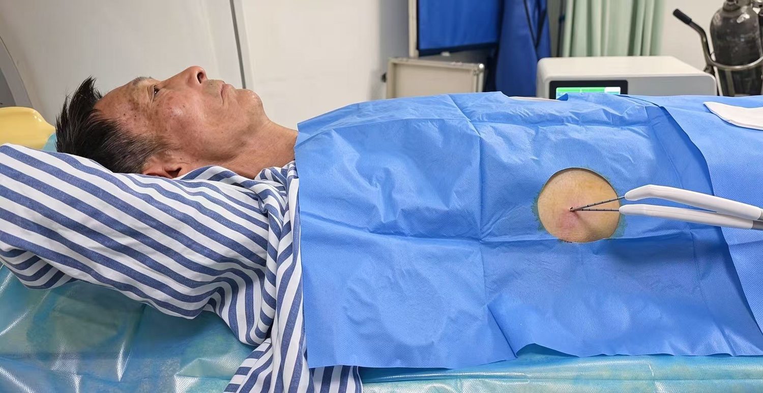 Cryoablation
